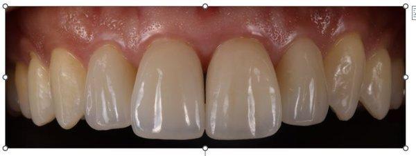 veneers with high translucency