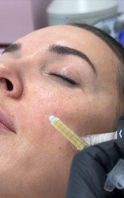 Skin booster facial