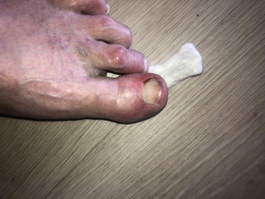 Toe Next day