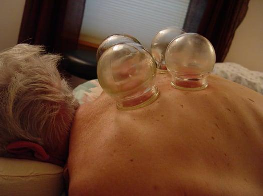 Yes, we provide cupping, the old fashioned way, as well as new ways.