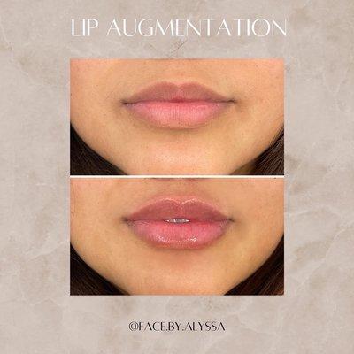 Lip augmentations