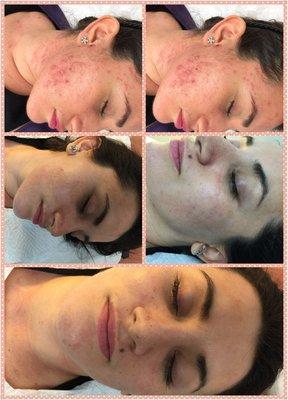 Acne and scar removal