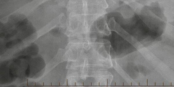 X-ray of anomalous heterogeneous mass with complex internal structures that is impacting the diaphragm.