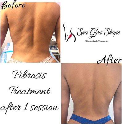 Before & After only 1 session of fibrosis back treatment