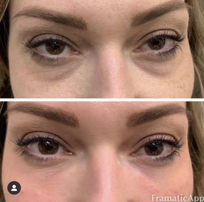 Undereye rejuvenation