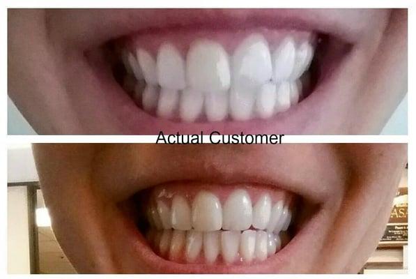 actual client. before and after smilelabs of pleasanton bay area smilelabs