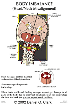 spinal subluxation