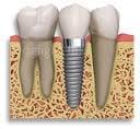 Dental implants to replace a tooth