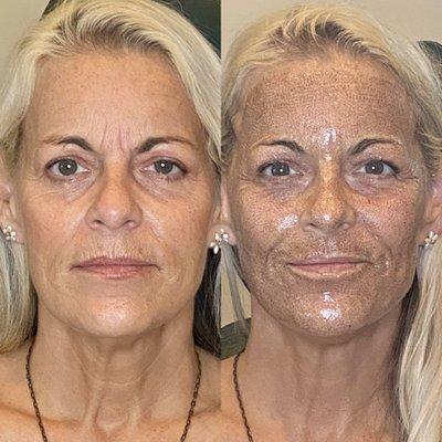 Before and After.
 Immediately visible skin tightening.