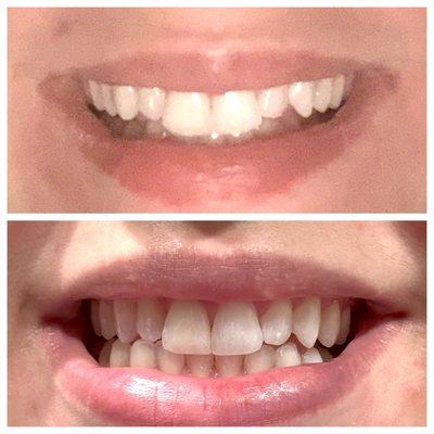 Before and After Invisalign. Fixed my severe overbite and straightened teeth