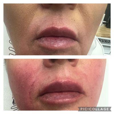 Revanesse Lip Filler