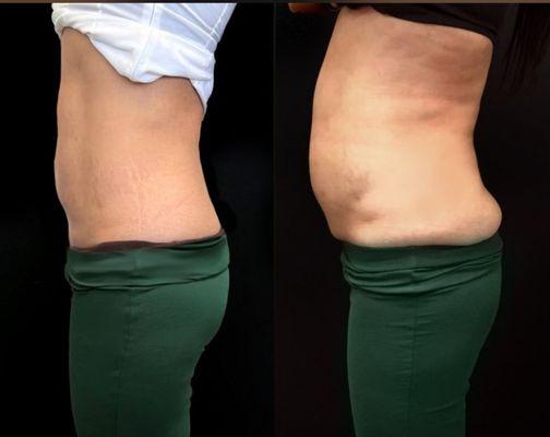 Before and after non-surgical Morpheus8 skin tightening and fat reduction plus Emsculp