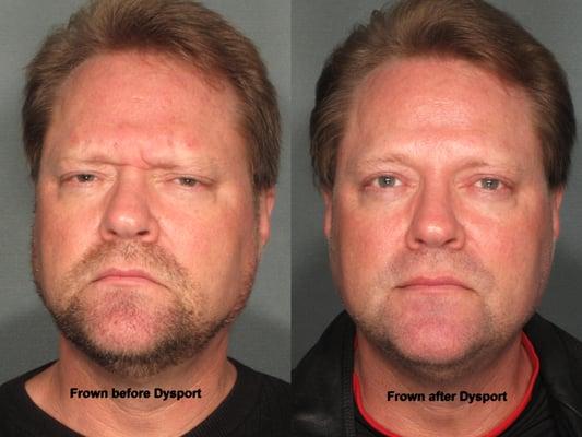 52 year old male before and after Dysport to frown line.