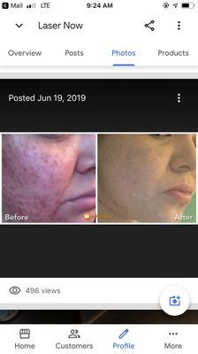 Bimodal laser for acne and acne scarring