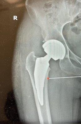 Hip replacement