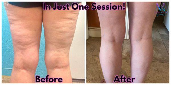 Cellulite removed after 1 session!