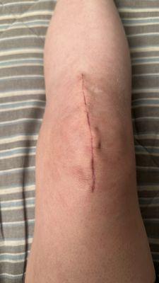 The scar I have left from my surgery of having a full knee replacement done