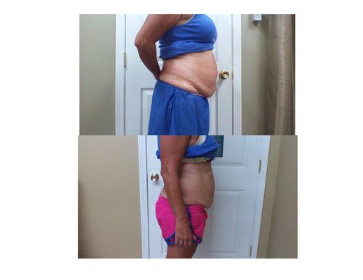 Cavitation Lipo Before & After 10