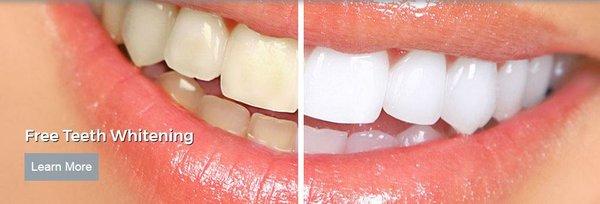 Free Whitening for Life!