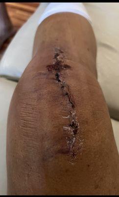 Day 7 after removing the surgical tape.