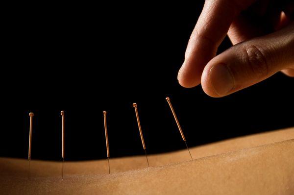 Acupuncture Available