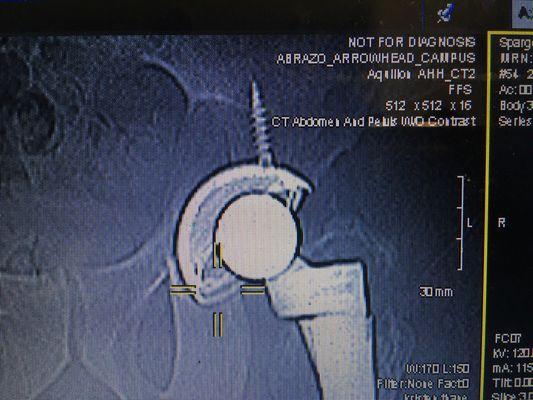 Close up left hip it deteriorating, cup Is worn out Dr Firestone did a great job but office would not let me talk with him, money thing