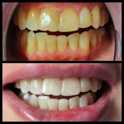 Incredible results after a 45-minute teeth whitening treatment at Smile Labs PDX. Her smile is completely transformed!