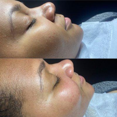 Beautiful before and after Neon Gold Purifying Facial