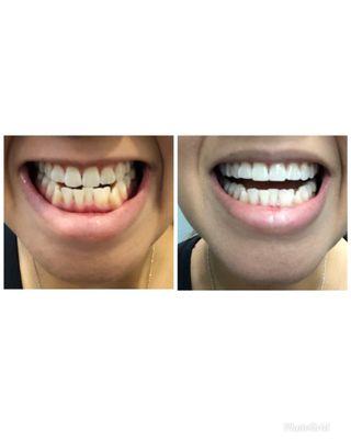 Before, and After Dr. Kim's work. My slight fillings for my chips were all done in one appointment!!