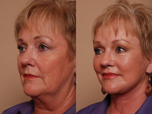 Refresher Facelift with Neck Lift, Brow Lift, Fat Transfer to Cheeks & Lips