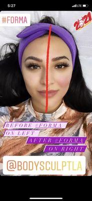 I also tried FORMA treatment on my face - one side done one not just to see the difference