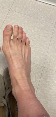 Right foot before surgery