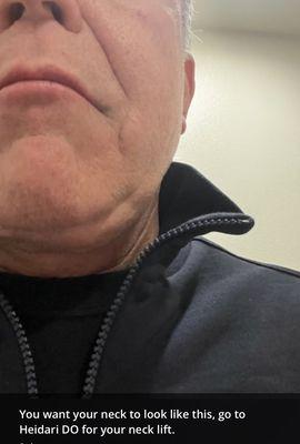 This is the 'after' picture of a Heidari neck lift.