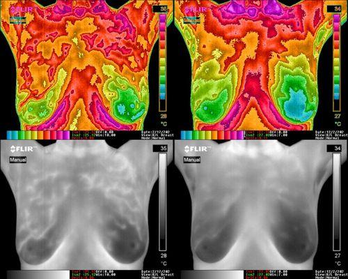 This client had abnormal patterns in R breast. Risk lowered and patterns reversed in nine months!