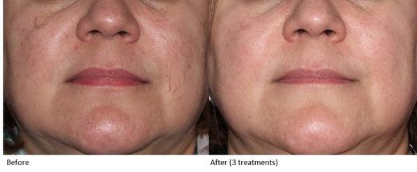 Sun Damage Laser Treatment: Before & After Photos from Dr. Rubenstein's Swedish Skin Institute (3 treatments).