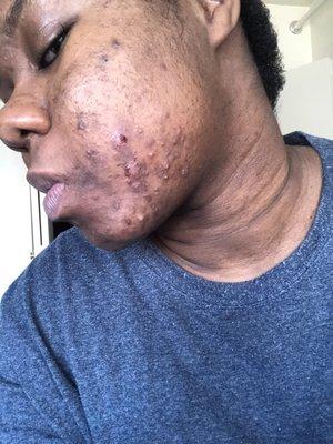 My skin getting worst after the treatment with Cynthia. Instead of admitting she was not qualified for this job.