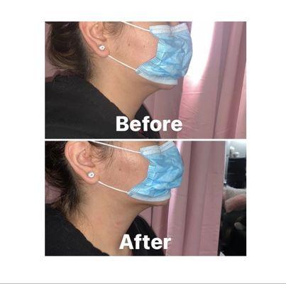 Before/After chin laser lipo