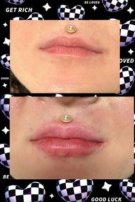 Lip filler. Customer is very happy with results