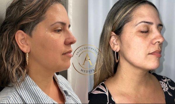 2 rounds of Kybella Fat Melting 
 A minimally invasive treatment to eliminate unwanted fat PERMANENTLY