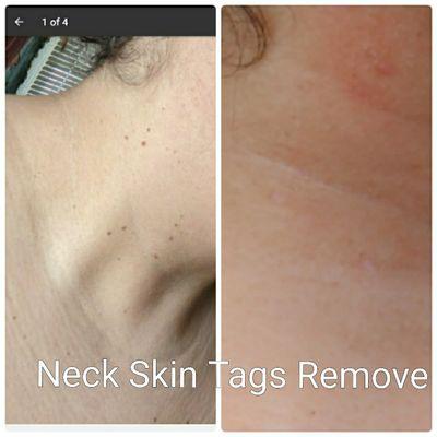 Neck skin tags remove before & after 2 months