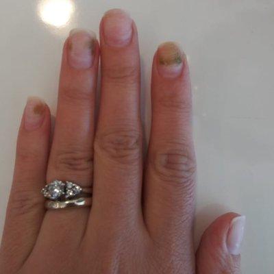 NAIL FUNGUS ON BOTH HANDS CAUSED BY UNIQUE NAILS.