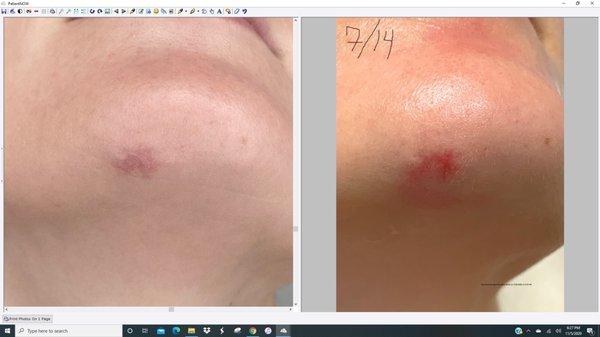 Chin scar before and after results with laser and PRP microneedling