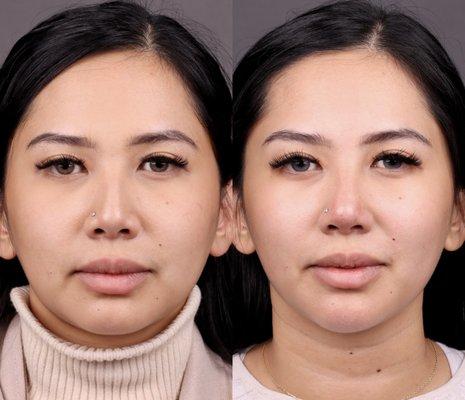 Liquid rhinoplasty