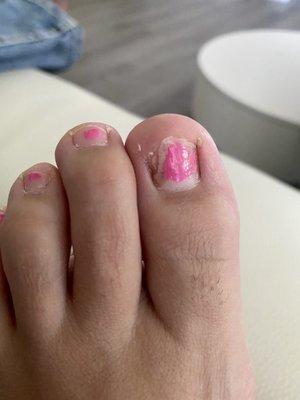 Horrible toe infection caused by dirty pedicure tools and now I've lost half my toenail.