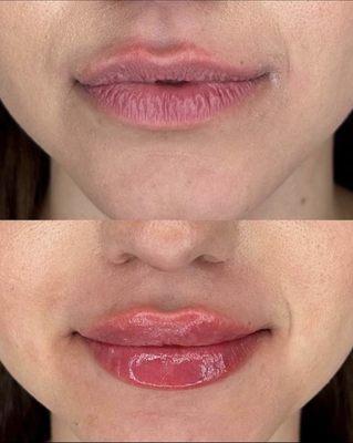 Lip Enhancement