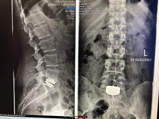 Cyborg spine!