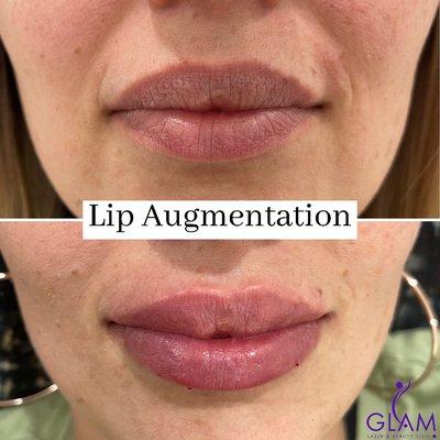 Lip Augmentation using 1/2 syringe of filler