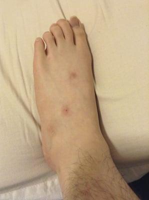 Bed bug bites on my legs. For months, my feet was never clean of bites because I would get fresh bites every day...It was terrible!