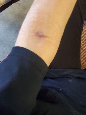 My latest blown vein 4/29/24.