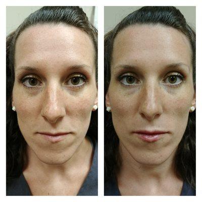 Restylane Lip Enhancement - Very Subtle